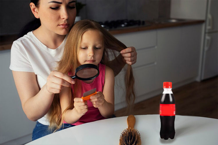 درمان فوری شپش با نوشابه